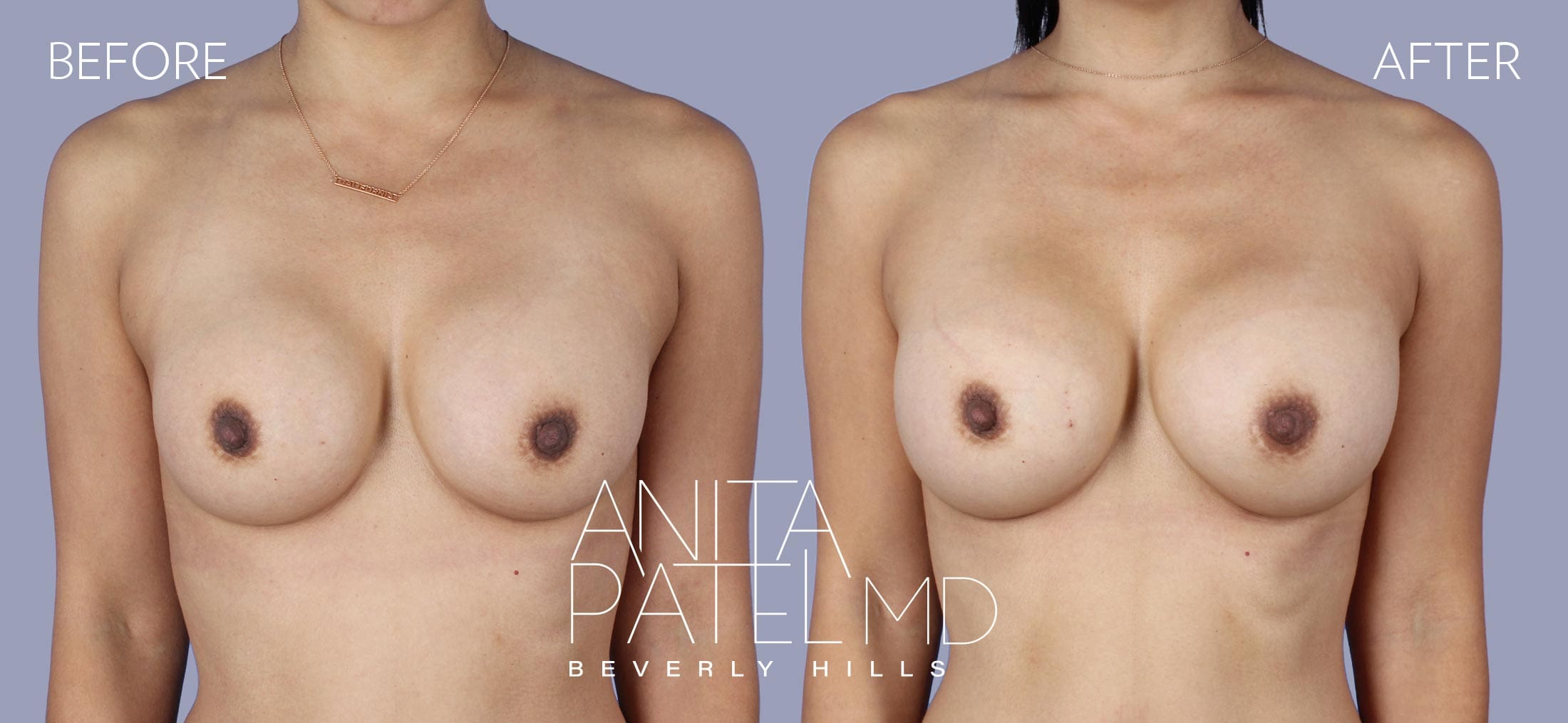 Implant Revision