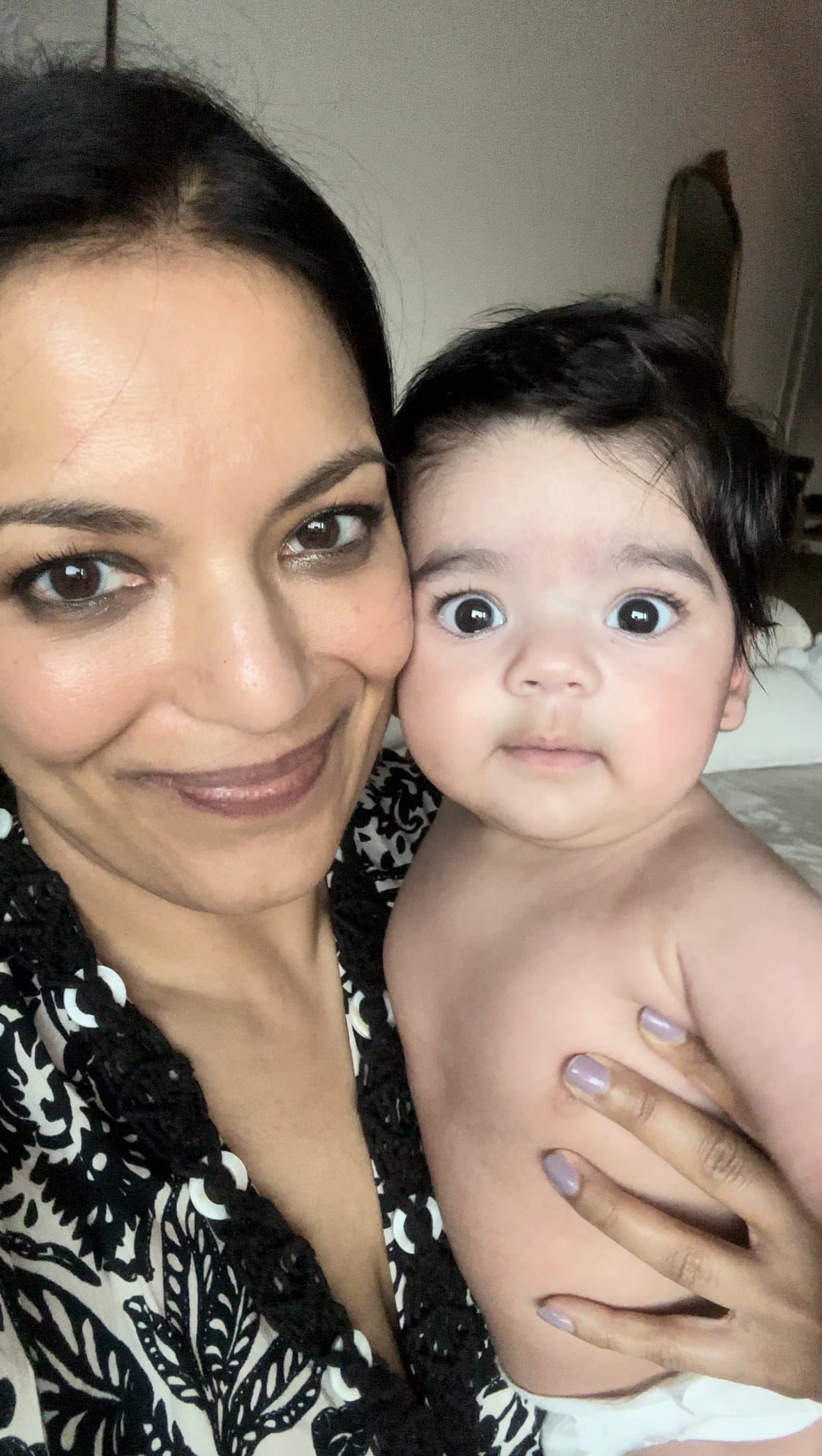Dr. Anita Patel before and after — Dr. Anita Patel, Beverly Hills (result 15)
