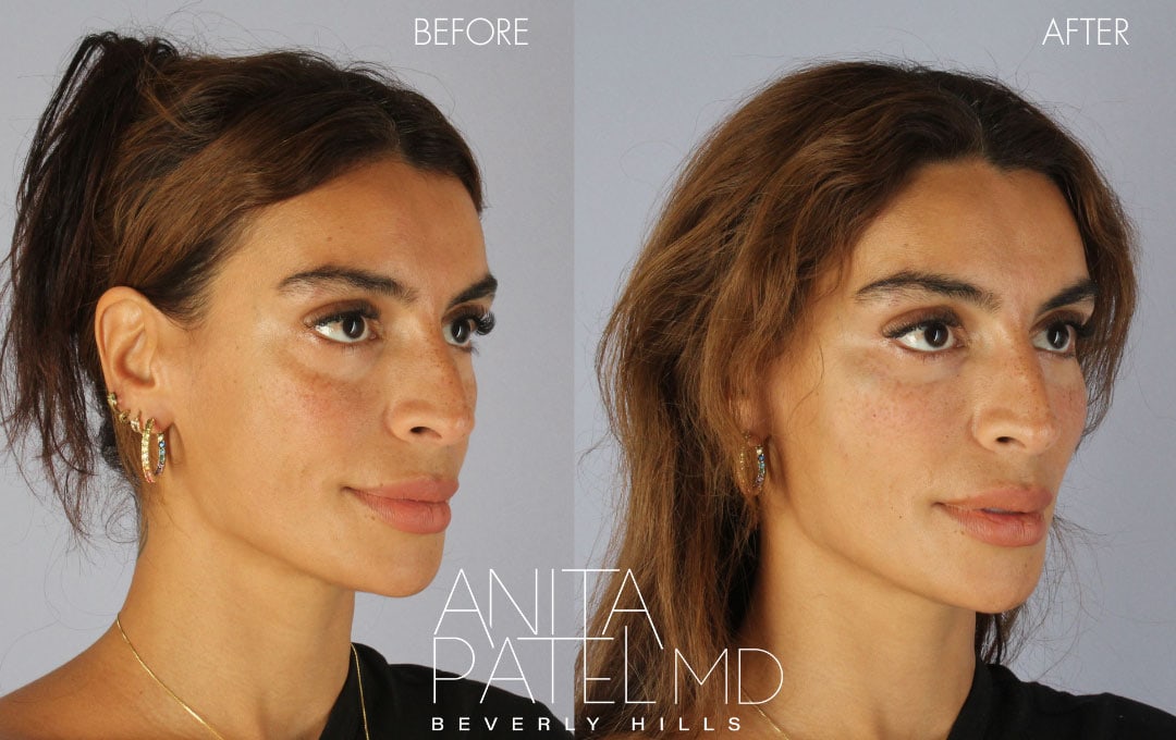 Anita Patel MD Elevates Aesthetic Medicine with Renuva, the Preferred Minimally Invasive Treatment before and after — Dr. Anita Patel, Beverly Hills