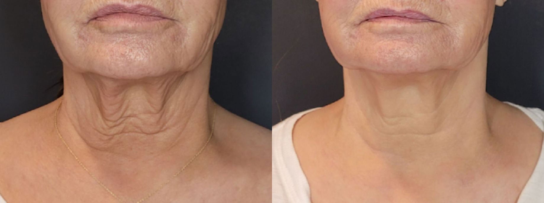 Sofwave before and after — Dr. Anita Patel, Beverly Hills (result 5)