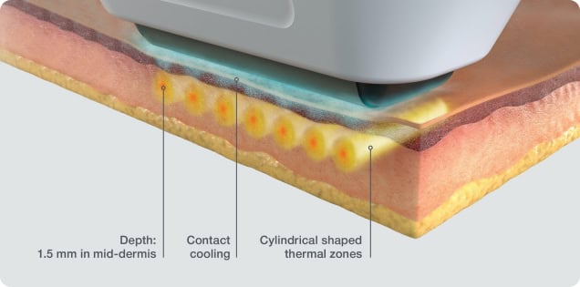 Sofwave before and after — Dr. Anita Patel, Beverly Hills (result 4)
