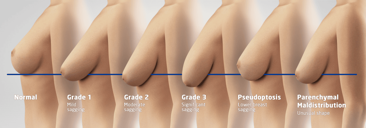 breast lift recovery stages