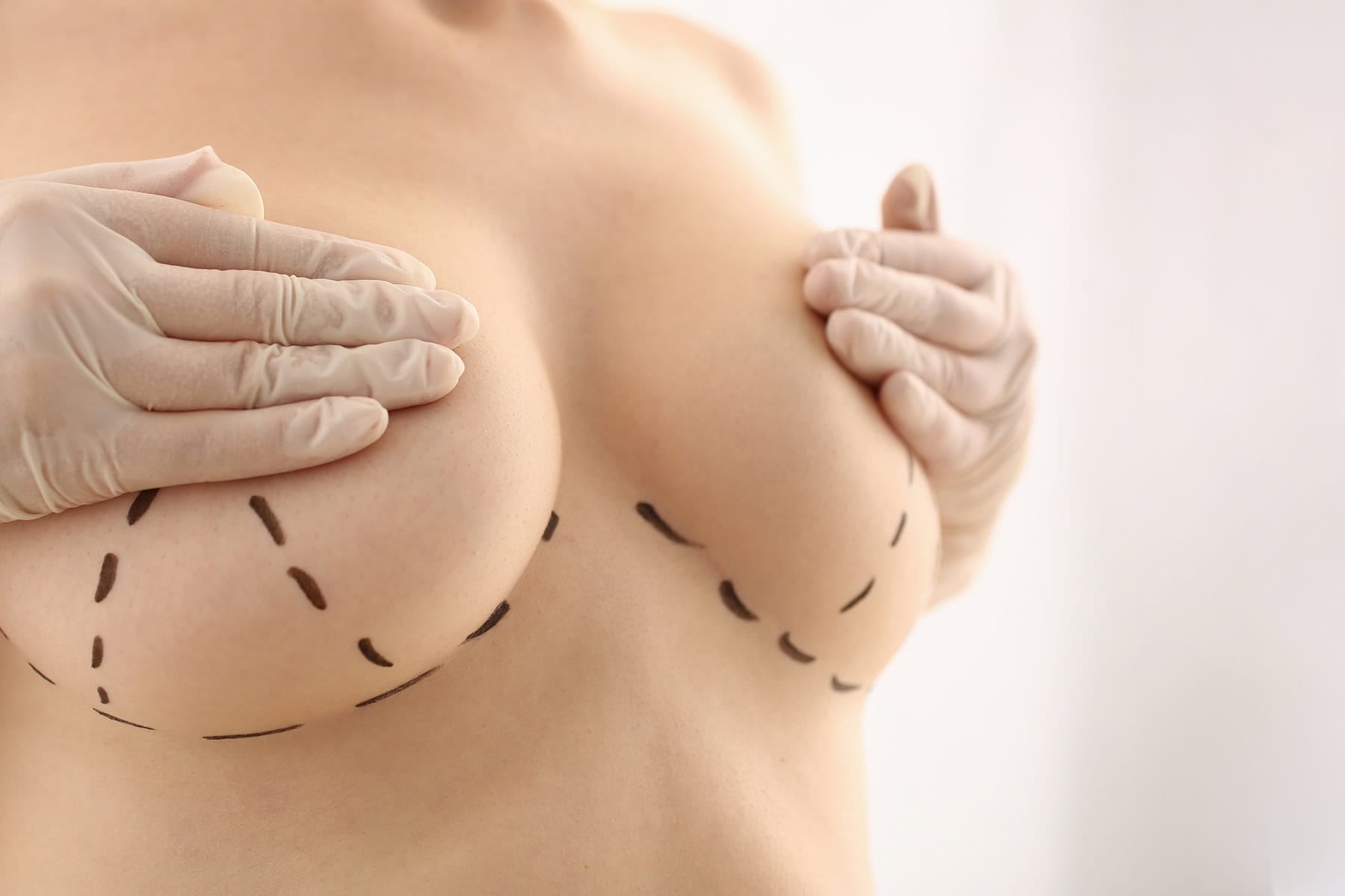 tummy tuck with breast lift
