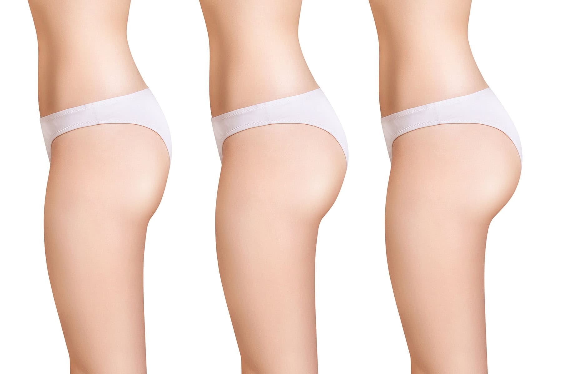 Top Benefits of AlloClae for Natural Body Contouring before and after — Dr. Anita Patel, Beverly Hills (result 3)