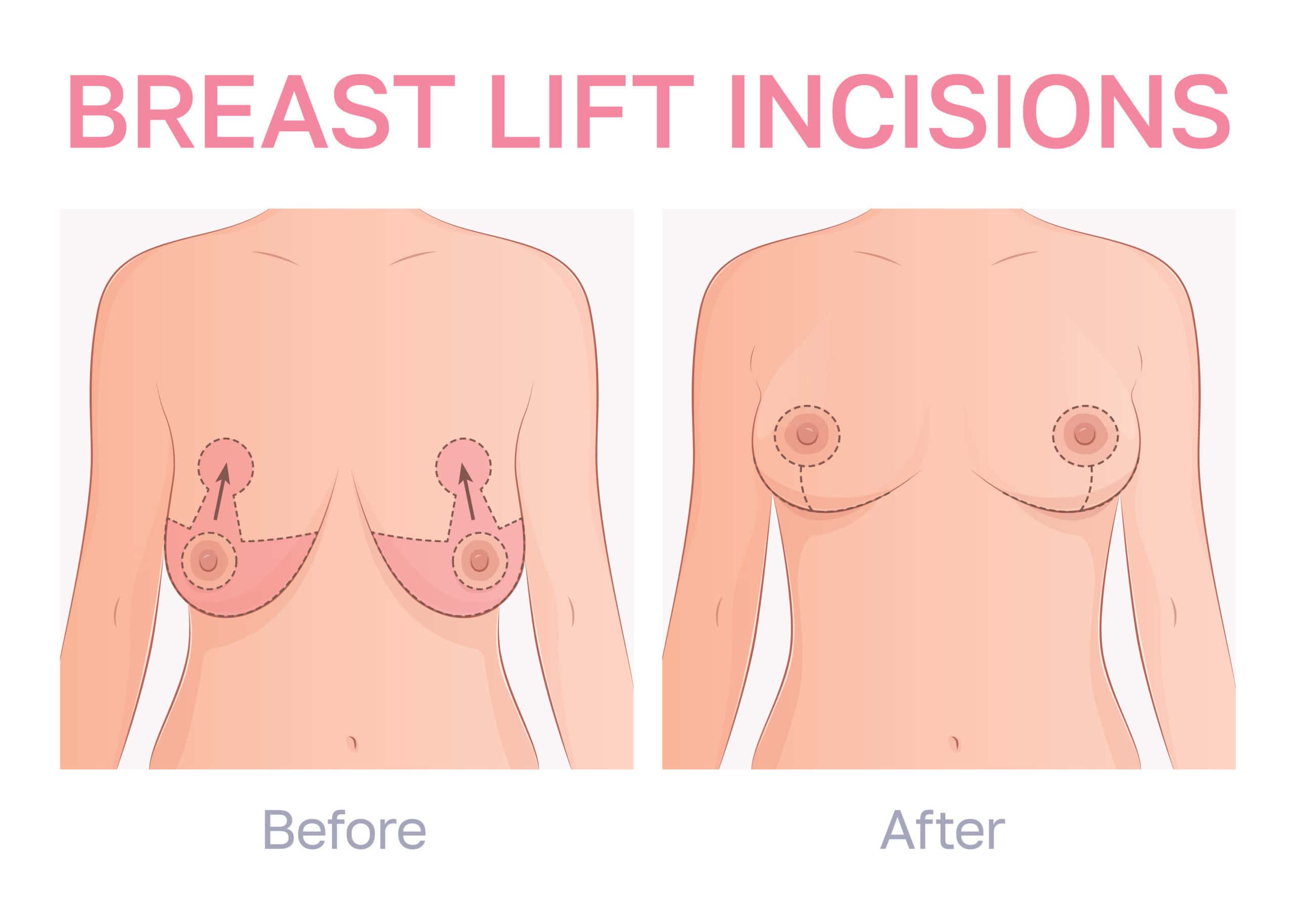 How Does a Breast Lift Work? Steps and Procedure Explained before and after — Dr. Anita Patel, Beverly Hills (result 2)